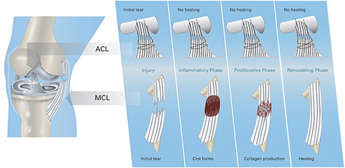 Illustration of ACL and MCL