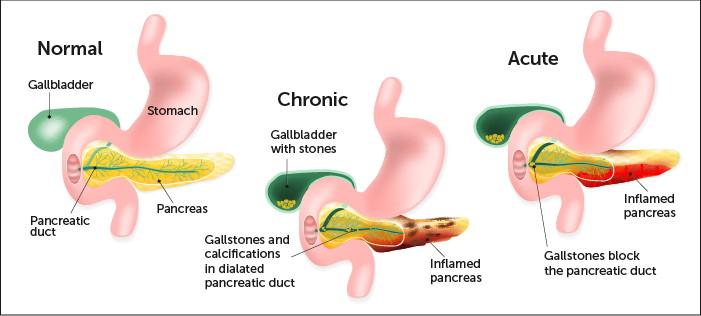 Pancreatitis Boston Children s Hospital pancreatitis-boston-children-s-hospital
