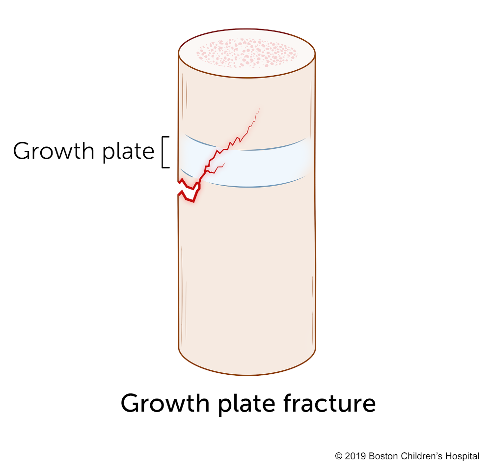 A growth plate fracture is a break in the bone that intersects the area of soft cartilage where the bone grows.
