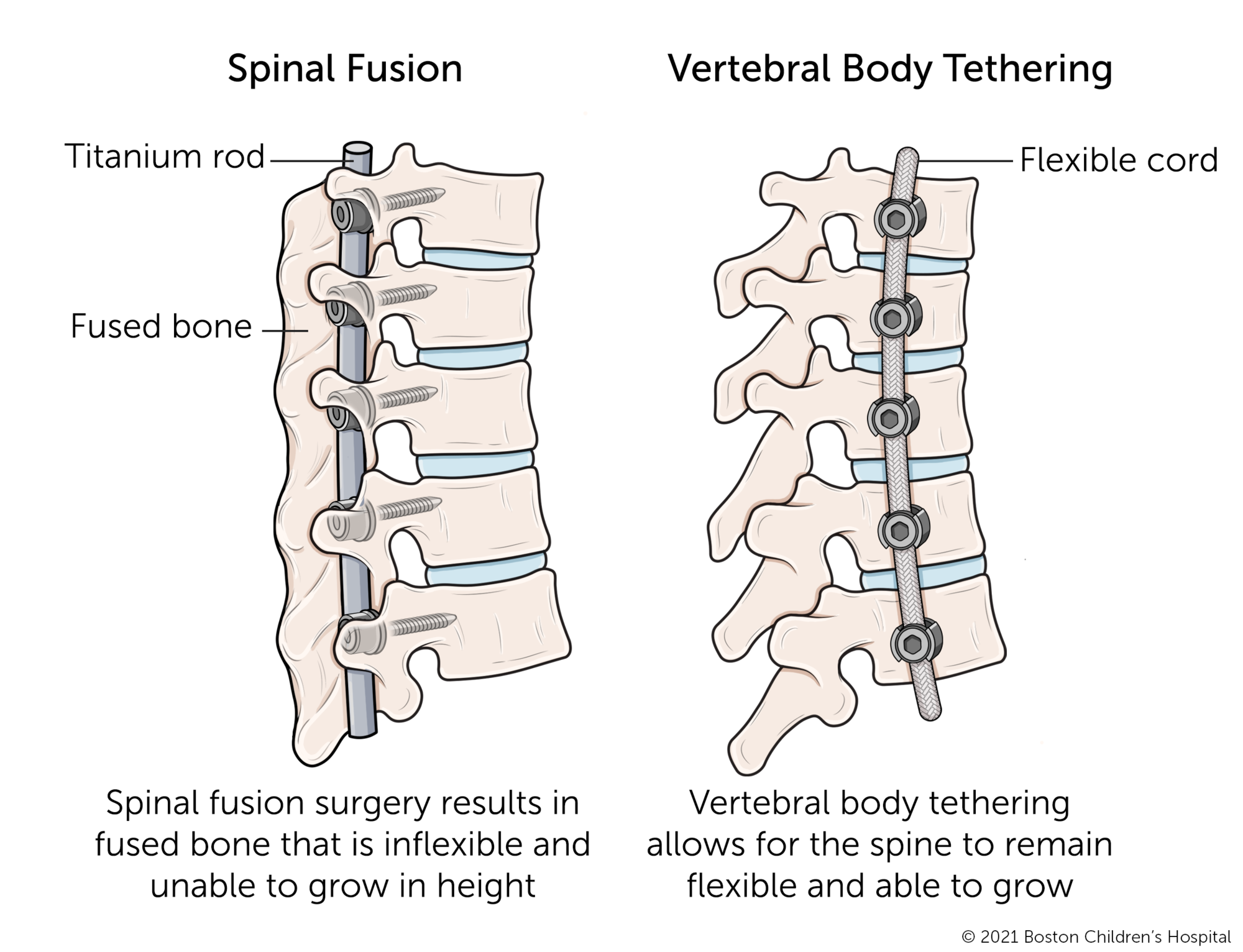 Spinal fusion compared to vertebral body tethering. Spinal fusion surgery results in fused bone that is inflexible and unable to grow in height. Vertebral body tethering allows for the spine to remain flexible and able to grow. 