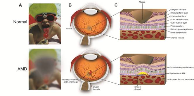 Damage Caused by wet AMD