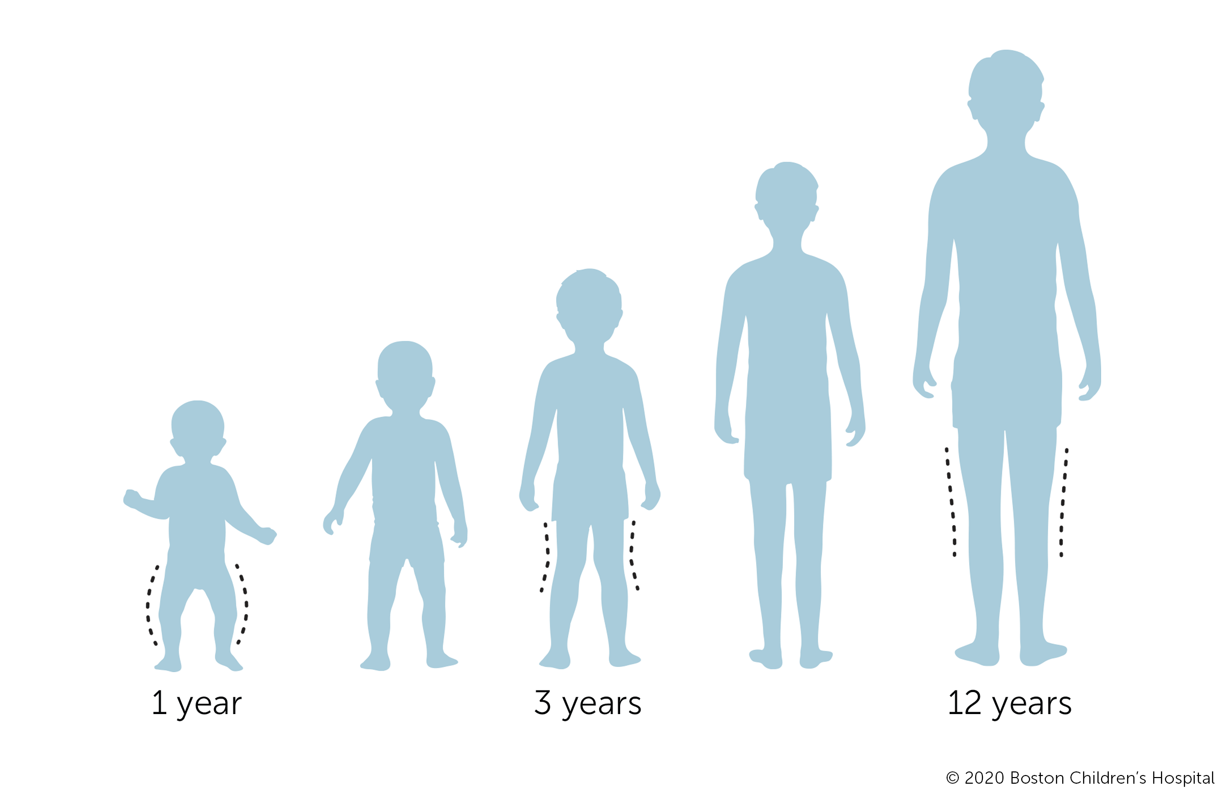 This is an illustration of a toddler with bowlegs at 1 year, knock knees at 3 years, and straight alignment at 12 years.