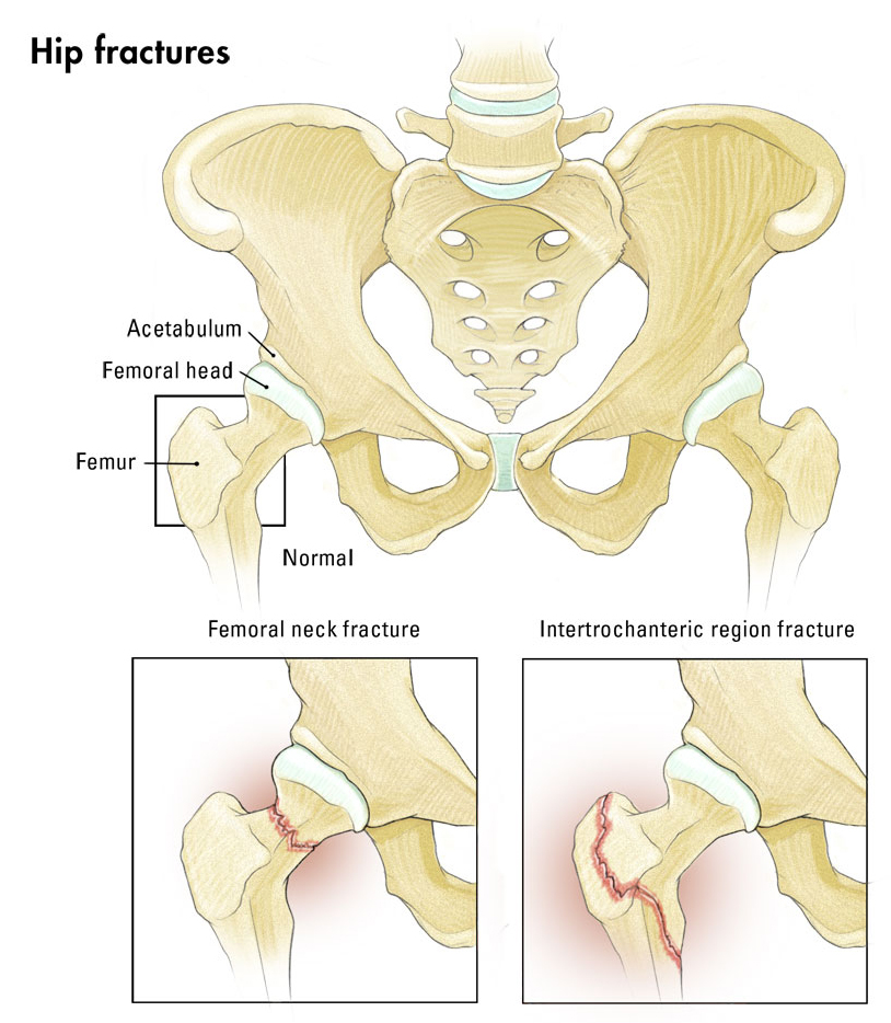 Hip fracture illustration
