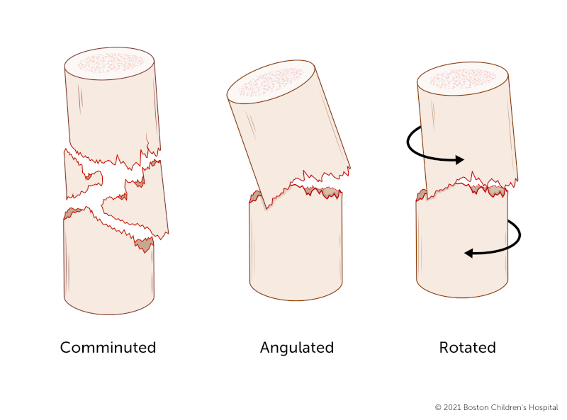 A communited fracture, angulated fracture, and rotated fracture.