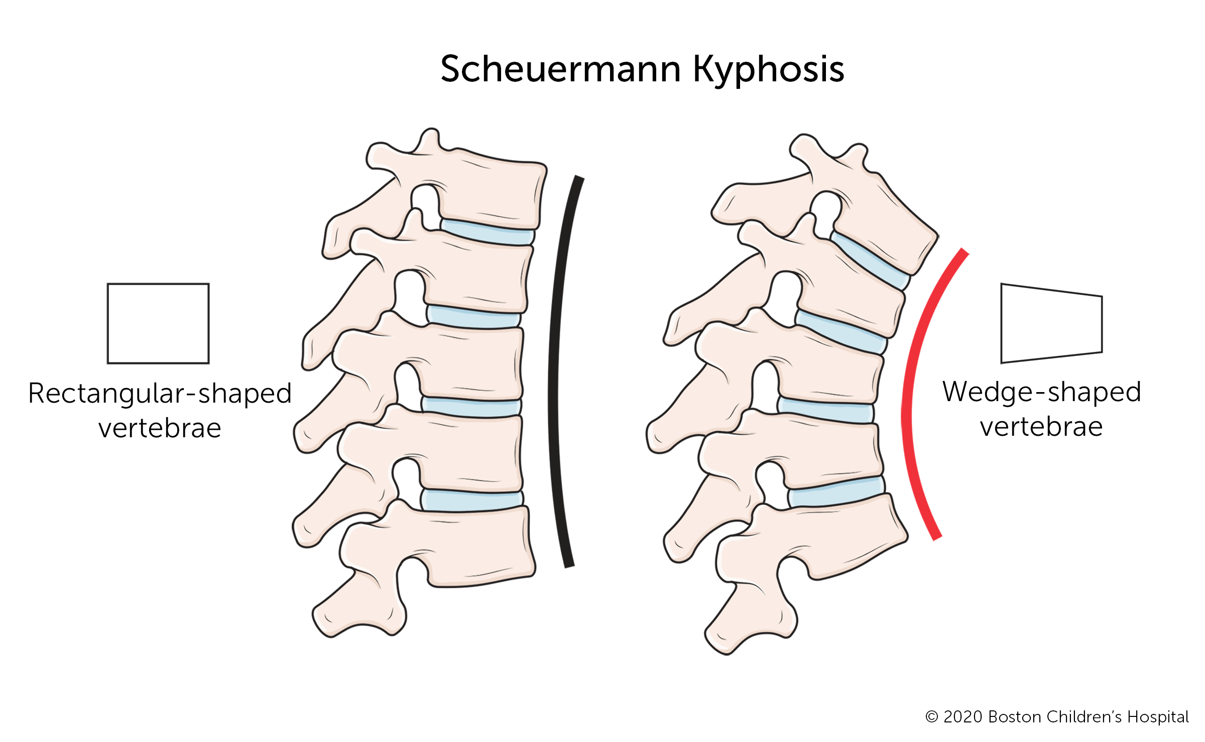 Scheuermann’s, or juvenile, kyphosis is a structural abnormality that occurs when several vertebrae in the thoracic spine develop a triangular (rather than rectangular) shape.