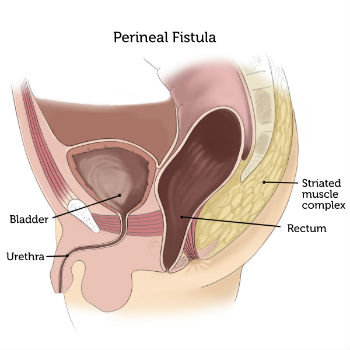 Perineal Fistula