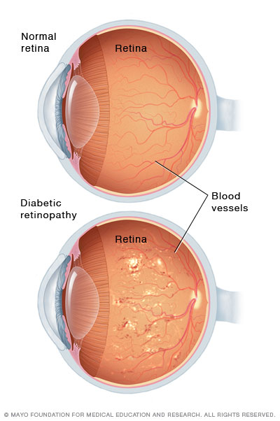 Eye with Diabetic Retinopathy