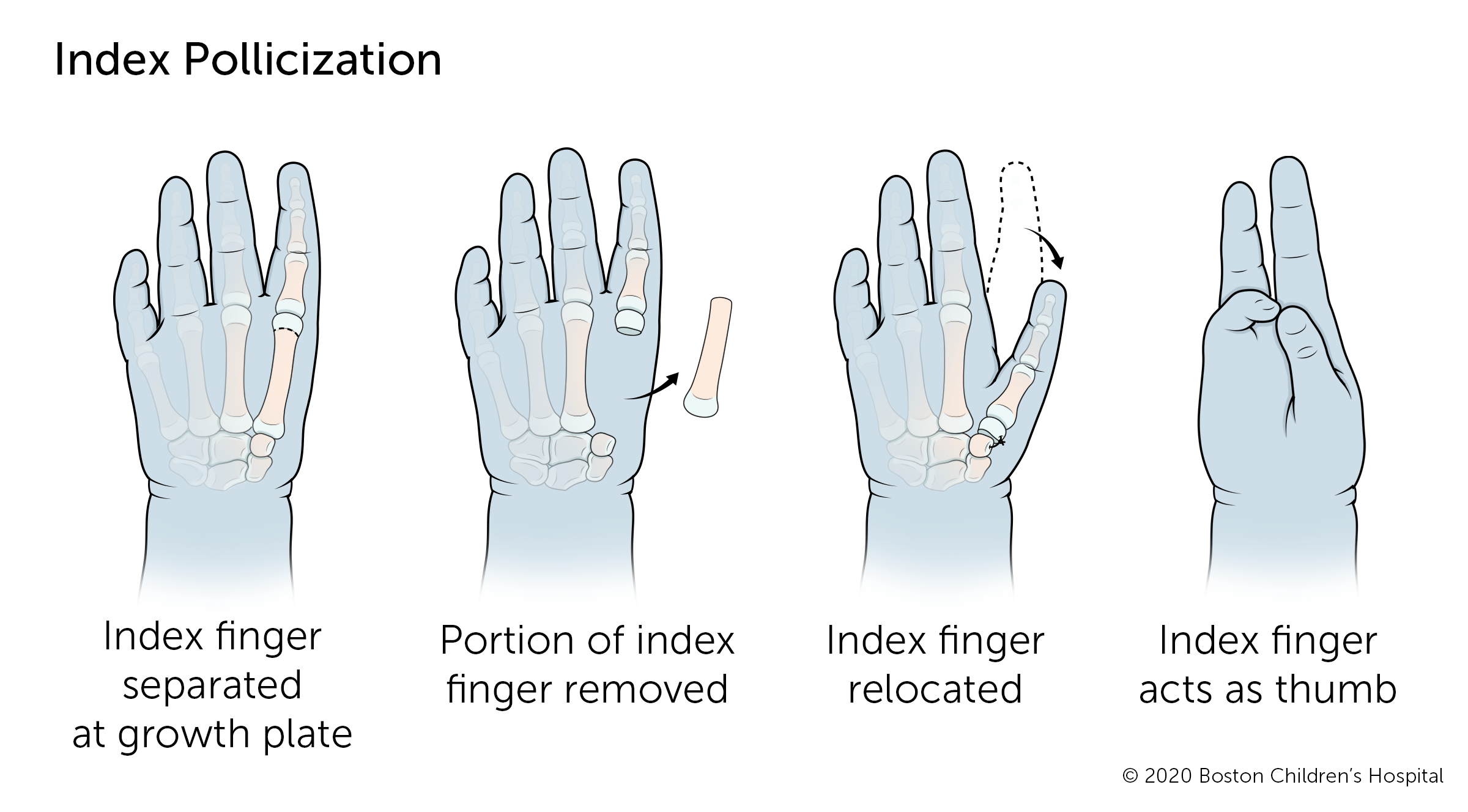 If the thumb is completely missing, index pollicization surgery moves the index finger into the thumb position. The index finger is separated at the growth plate, a section of the finger is removed from the hand, and the remaining finger is relocated to where it can serve as a thumb.