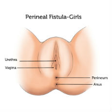 Perineal Fistula