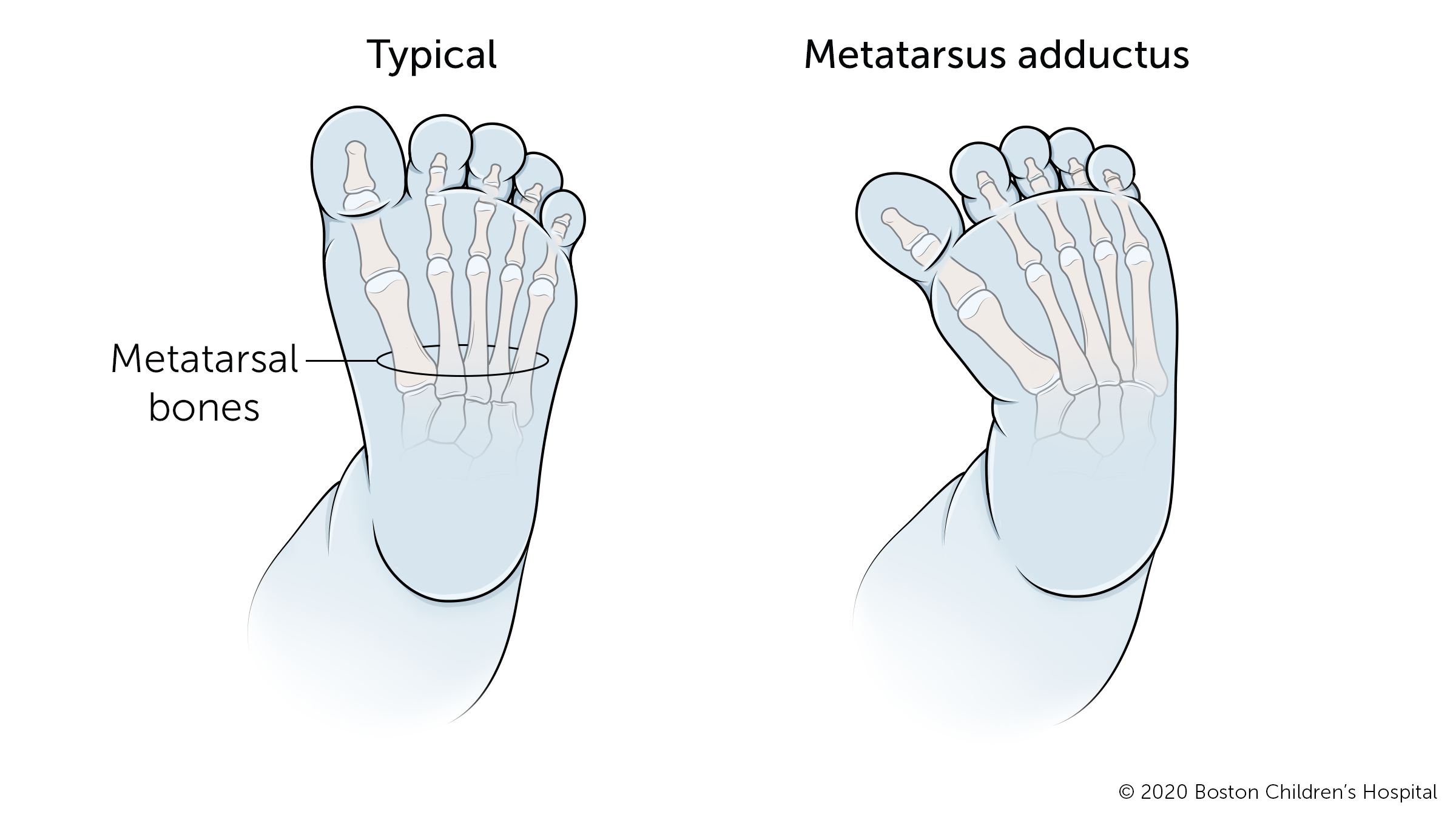 This is an illustration of a typical foot and a foot with metatarsus adductus.
