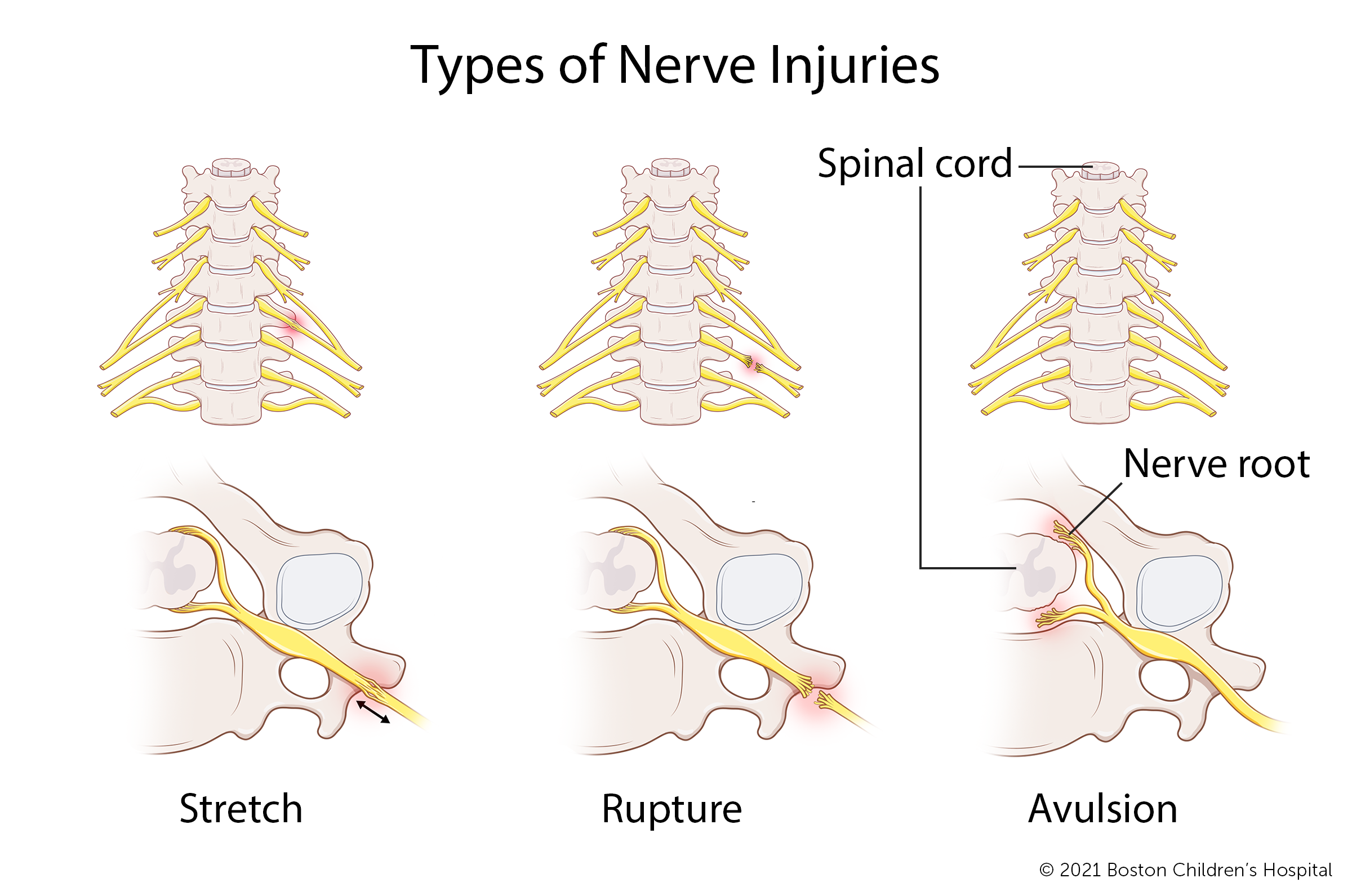 In a stretch brachial plexus injury, the nerve has been stretched, but not torn. In a rupture brachial plexus injury, the nerve has been torn, but remains attached to the spinal cord. In an avulsion brachial plexus injury, the nerve root has separated from the spinal cord. 