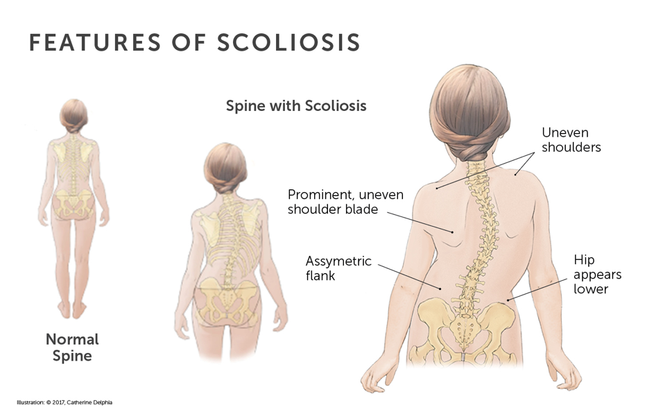 This is a look at the features of scoliosis.