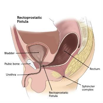 Rectoprostatic Fistula