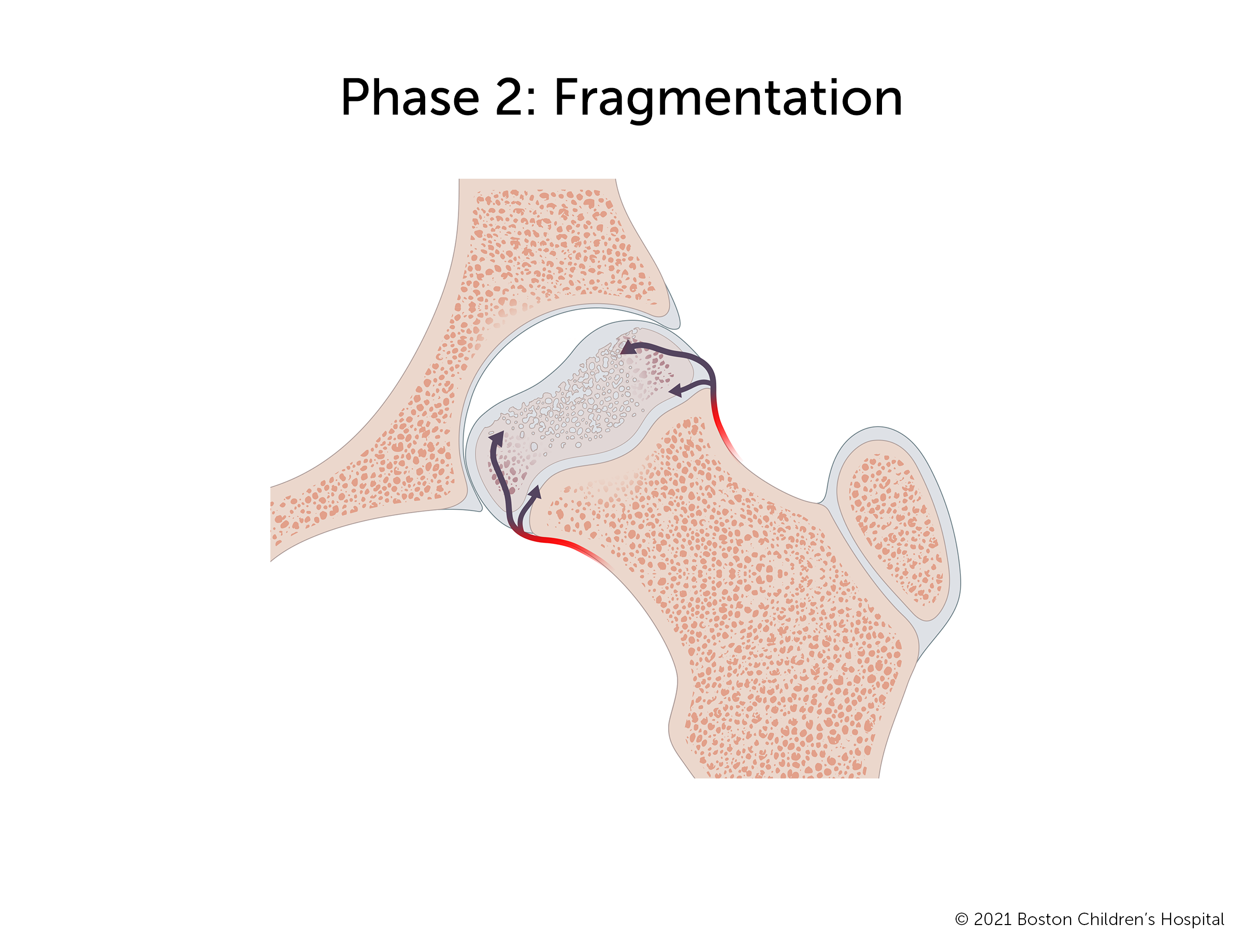 Phase 2: Fragmentation. As the interrupted blood flow continues, the pocket in the hip socket grows larger.