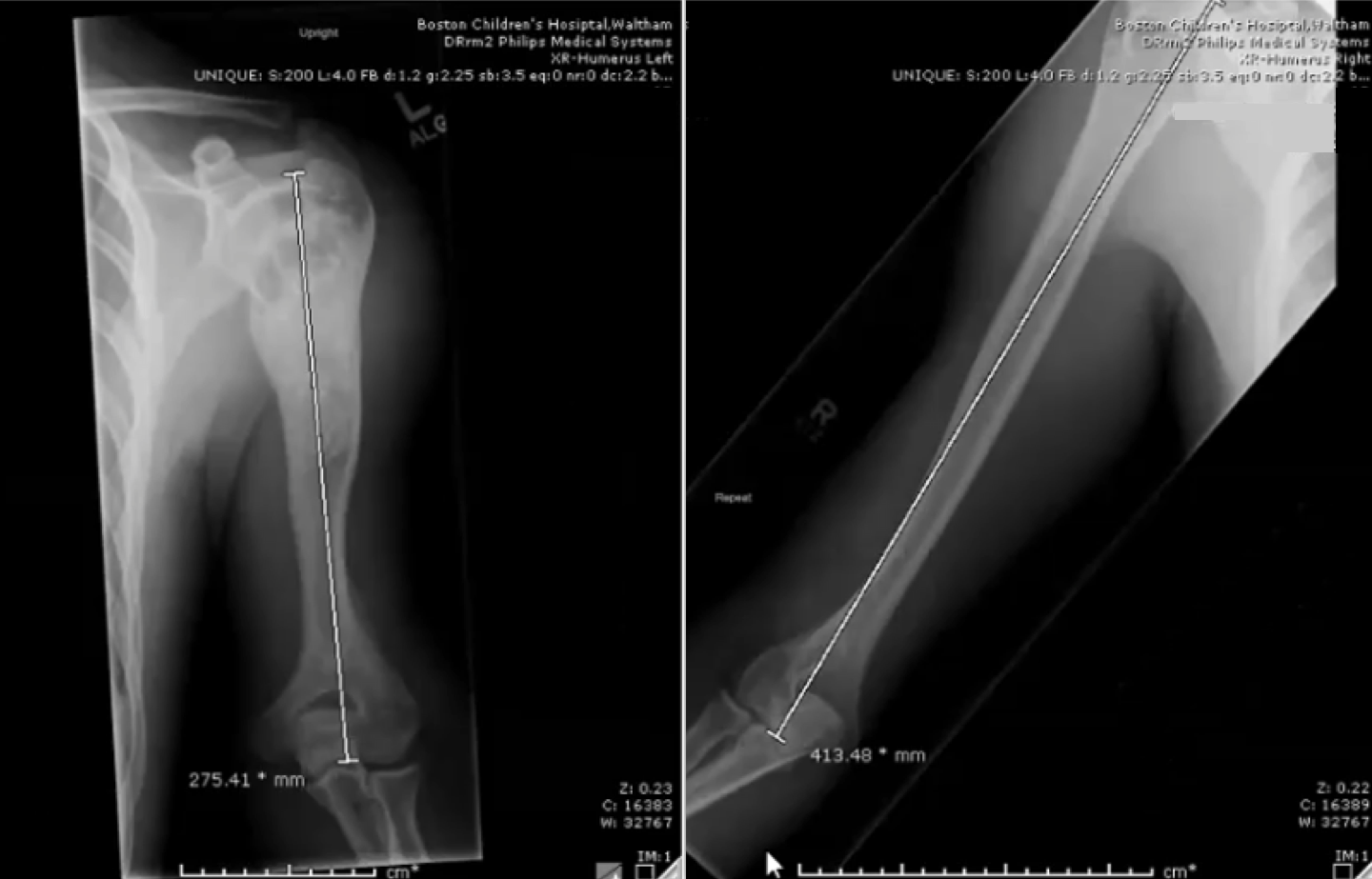 An update on the intramedullary implant in limb lengthening: A quinquennial  review Part 1: The further influence of the intramedullary nail in limb  lengthening - ScienceDirect