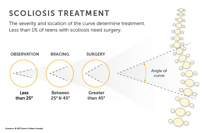 Scoliosis Treatment