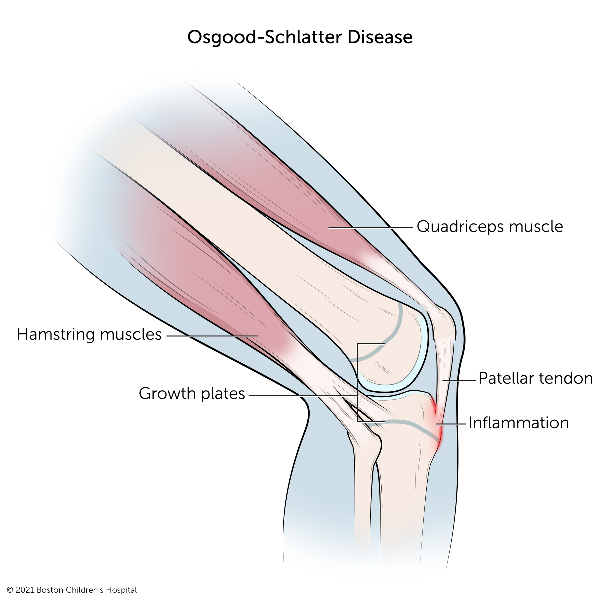 Illustration: Osgood-Schlatter disease