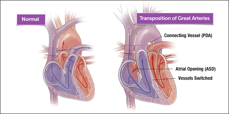 illustration of a normal heart and a heart with transposition of the great arteries (TGA)