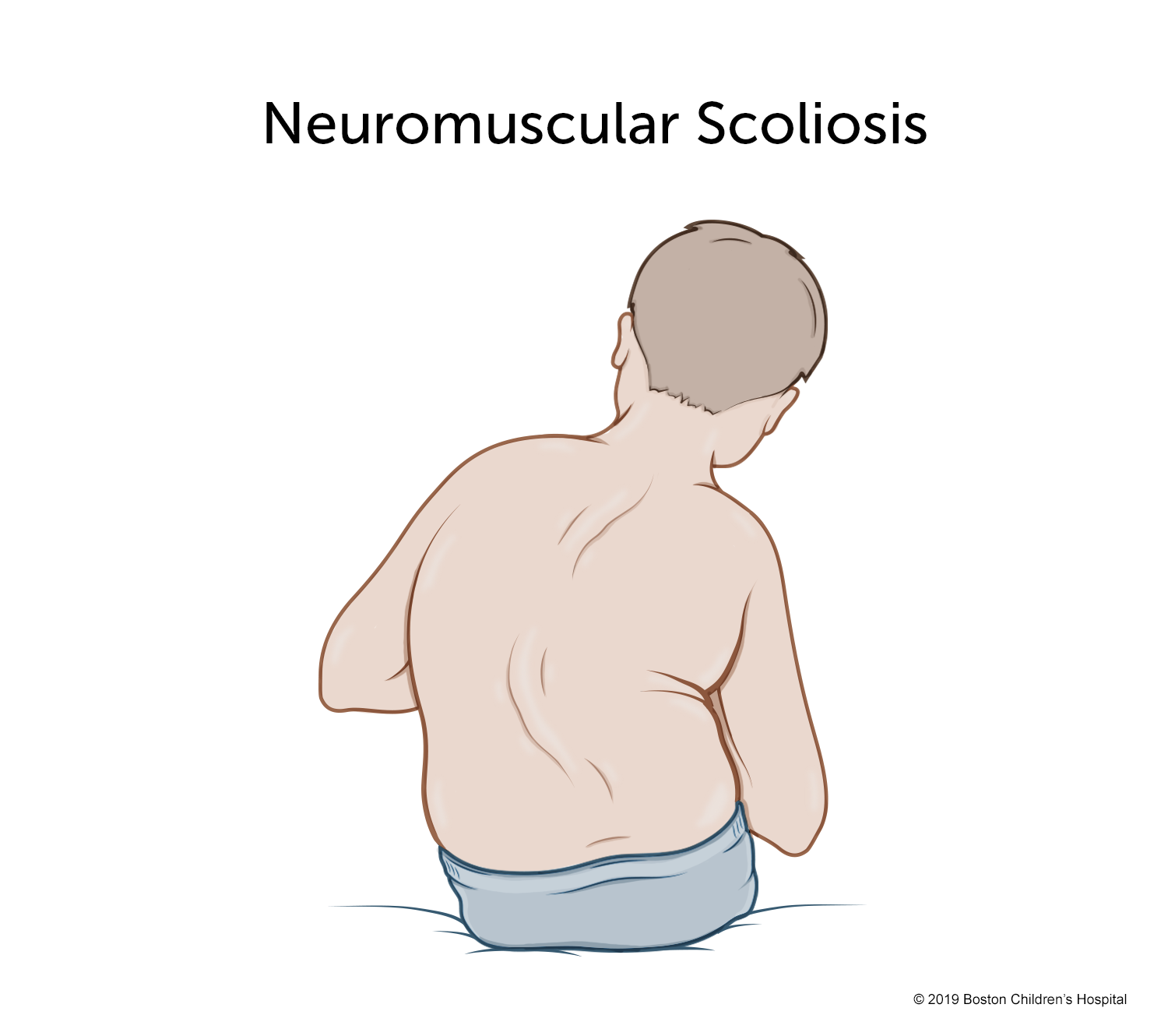 Neuromuscular scoliosis illustration