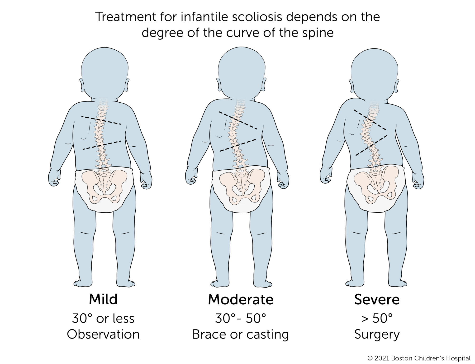 Comparison of mild, moderate, and severe infantile scoliosis. 