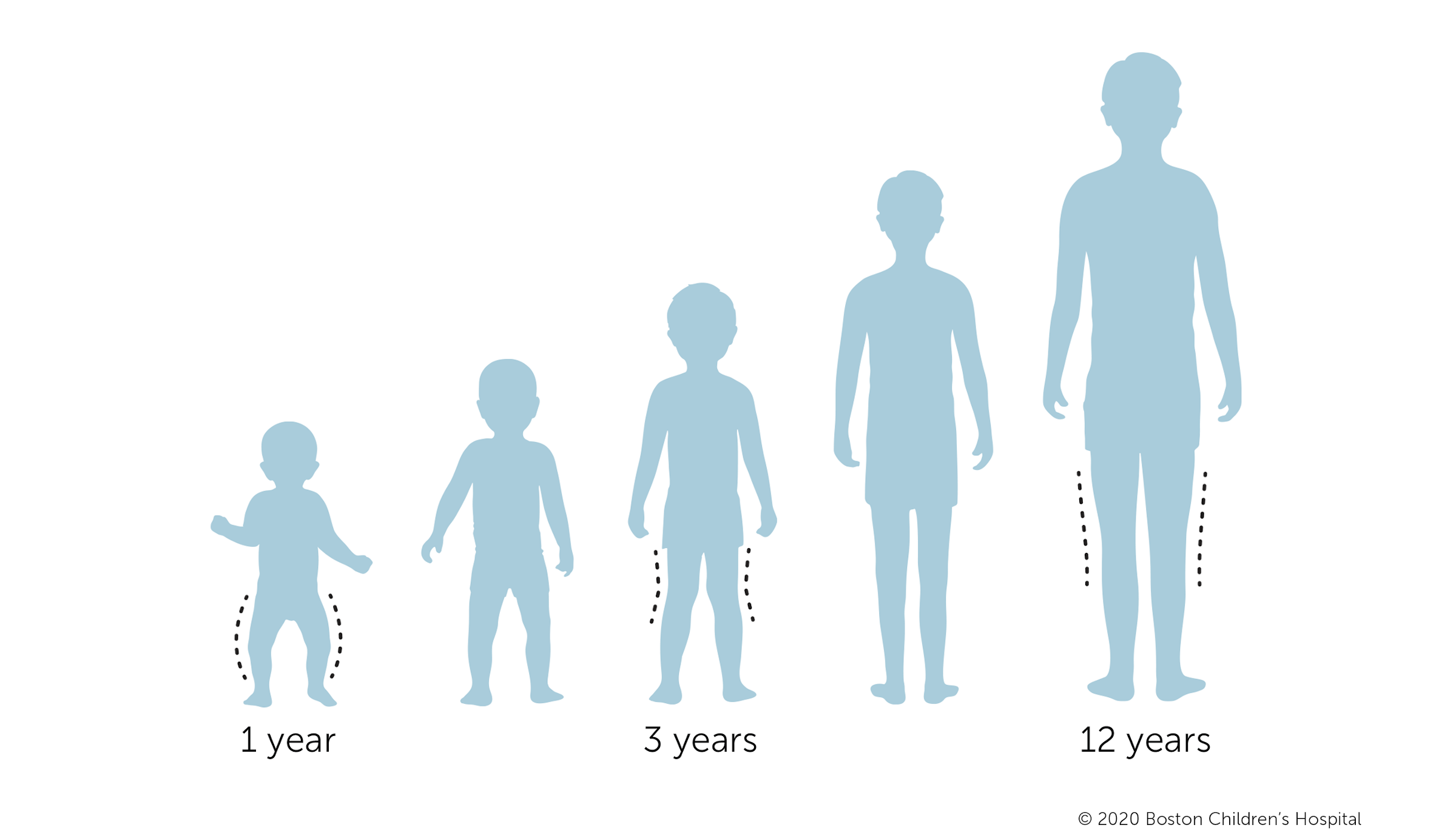 This is an image of a child with bowlegs at 1 year, knock knees at 3 years, and straight alignment by age 12.