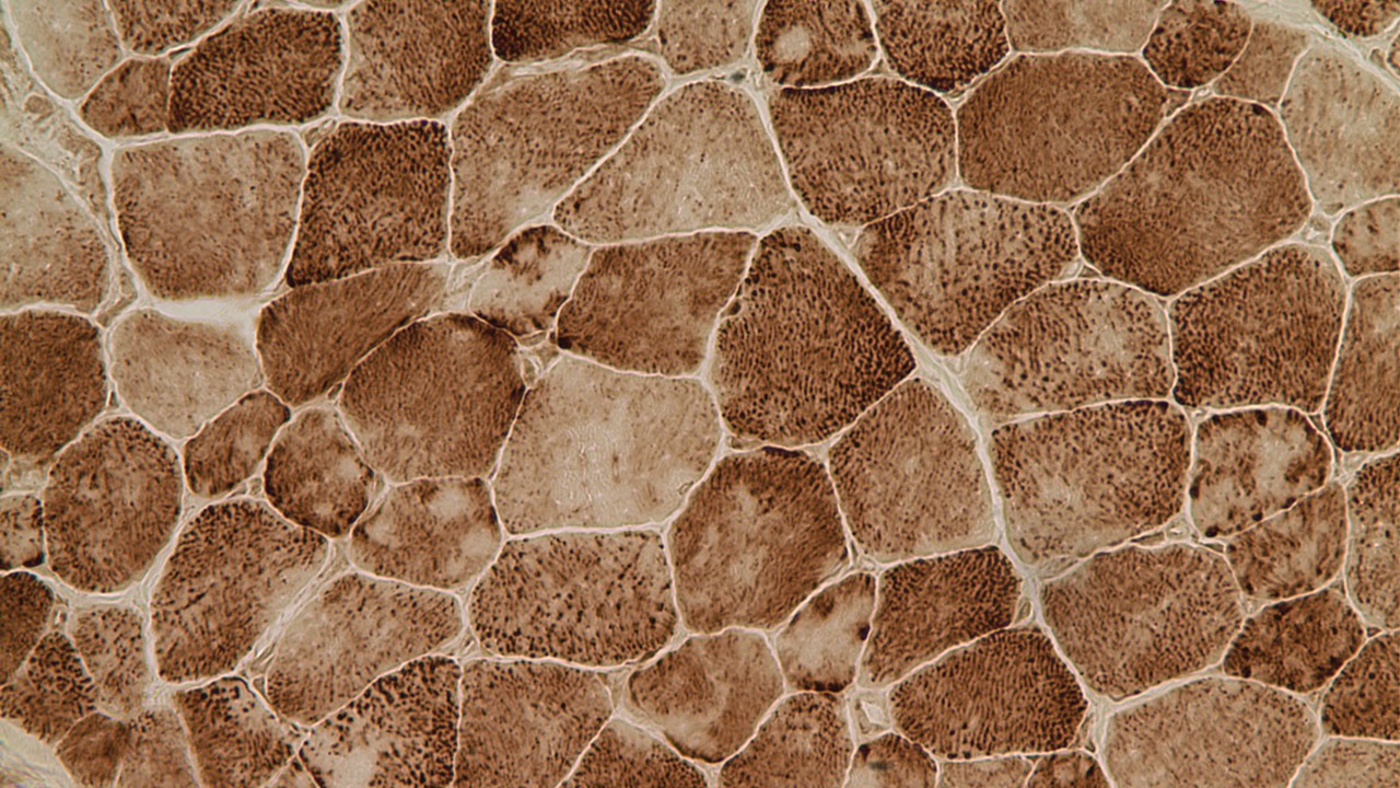 Muscle cells exhibiting the classic minicores (lighter core areas within the cells) observed in Multiminicore disease.