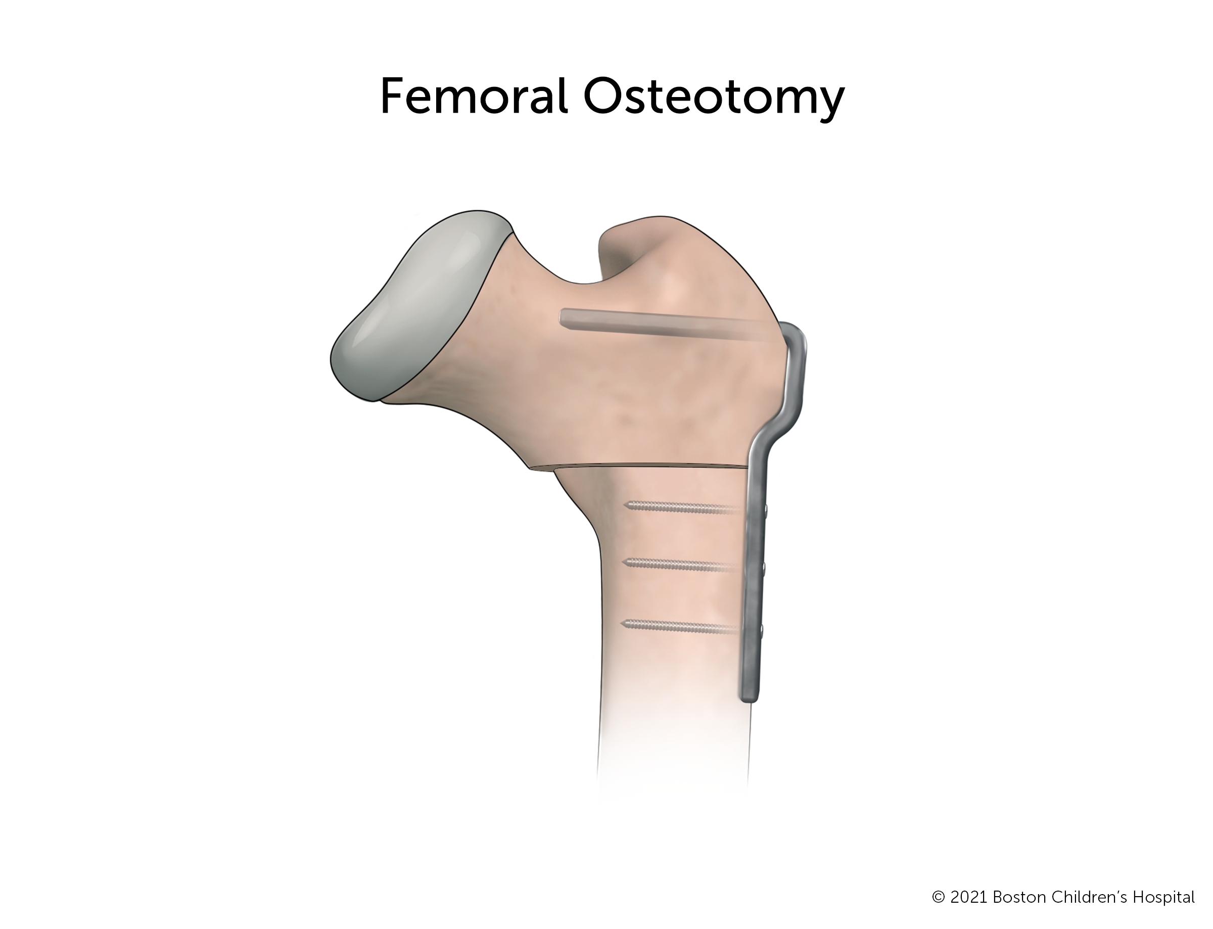 A femoral head after a femoral osteotomy. The bone has been cut and the top of the femoral head has been repositioned so it will fit more securely in the hip socket. The two pieces of bone are held together with a metal plate.