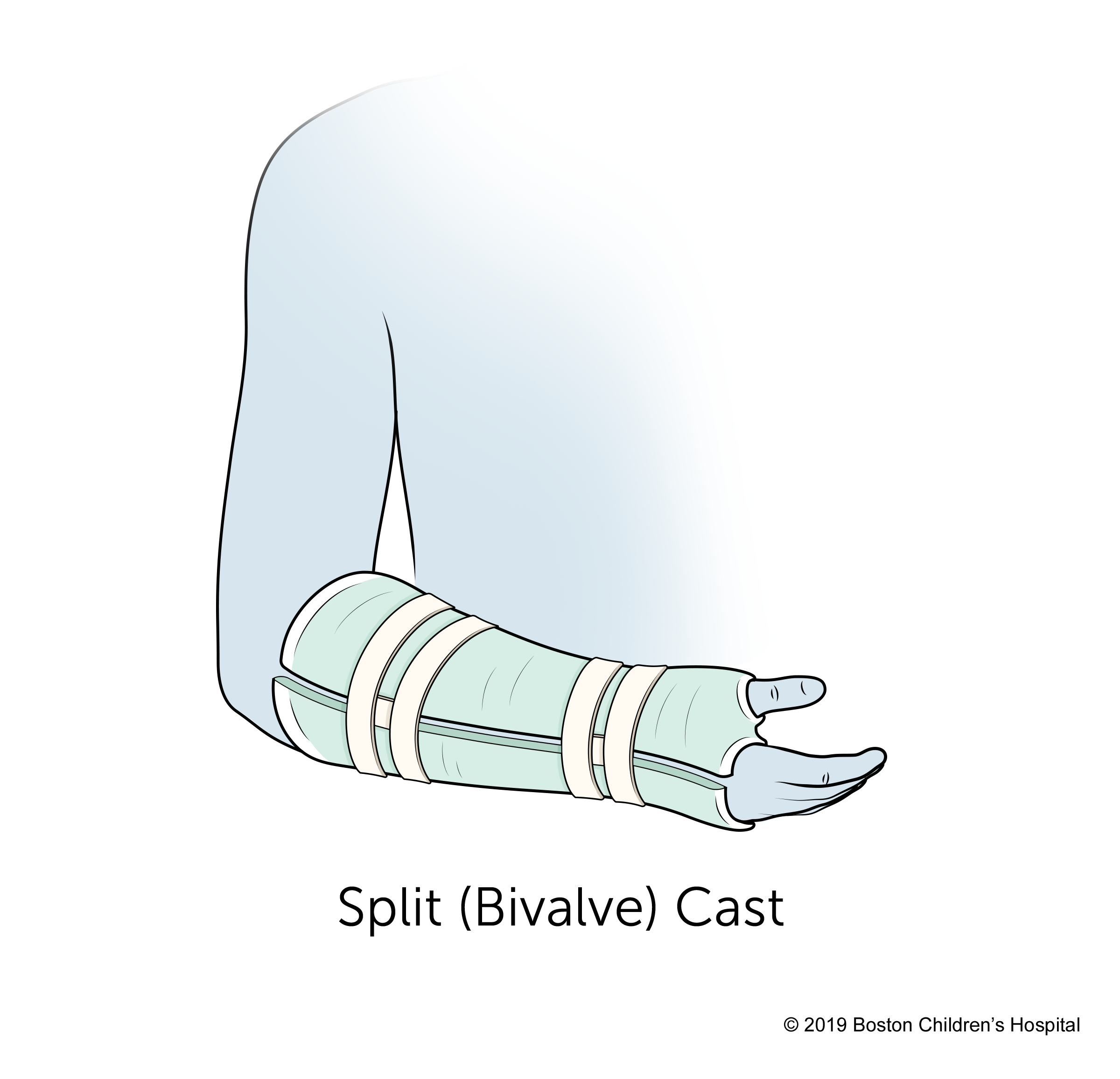 A split (bivalve) cast.