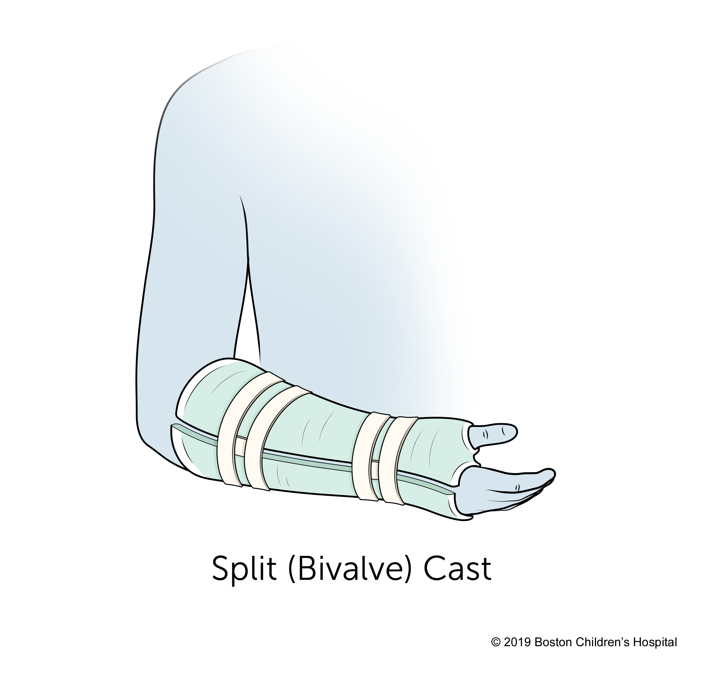 Types of Short Arm Casts: Which One Is Right for You?