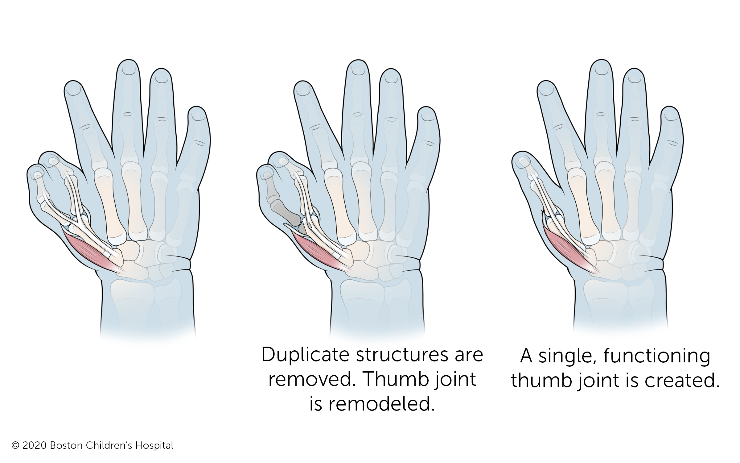 The duplicate bone and other structures are removed and the thumb joint where the two bones previously branched off is remodeled to create a single, functioning thumb and thumb joint.
