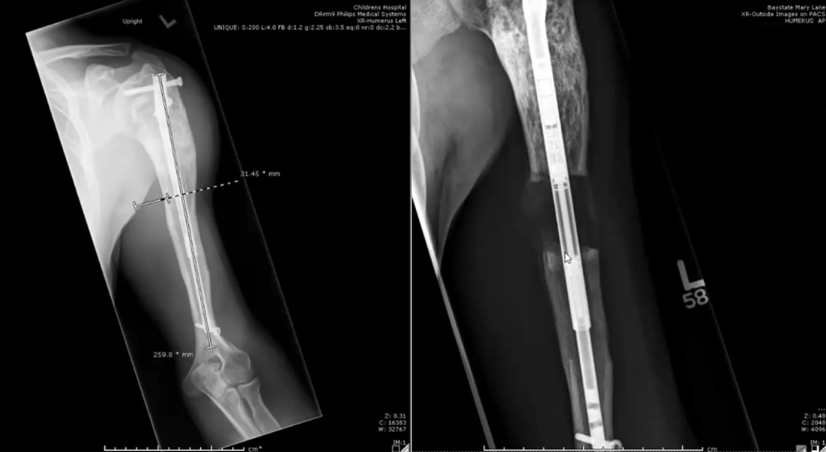Two x-ray images of a patient’s left arm at two stages of arm lengthening. In the first, a lengthening rod has been surgically attached to the bone in the upper arm. In the second, the bone has been cut and there is a space between the ends of bone that the rod is supporting. New bone growth is visible in this space.