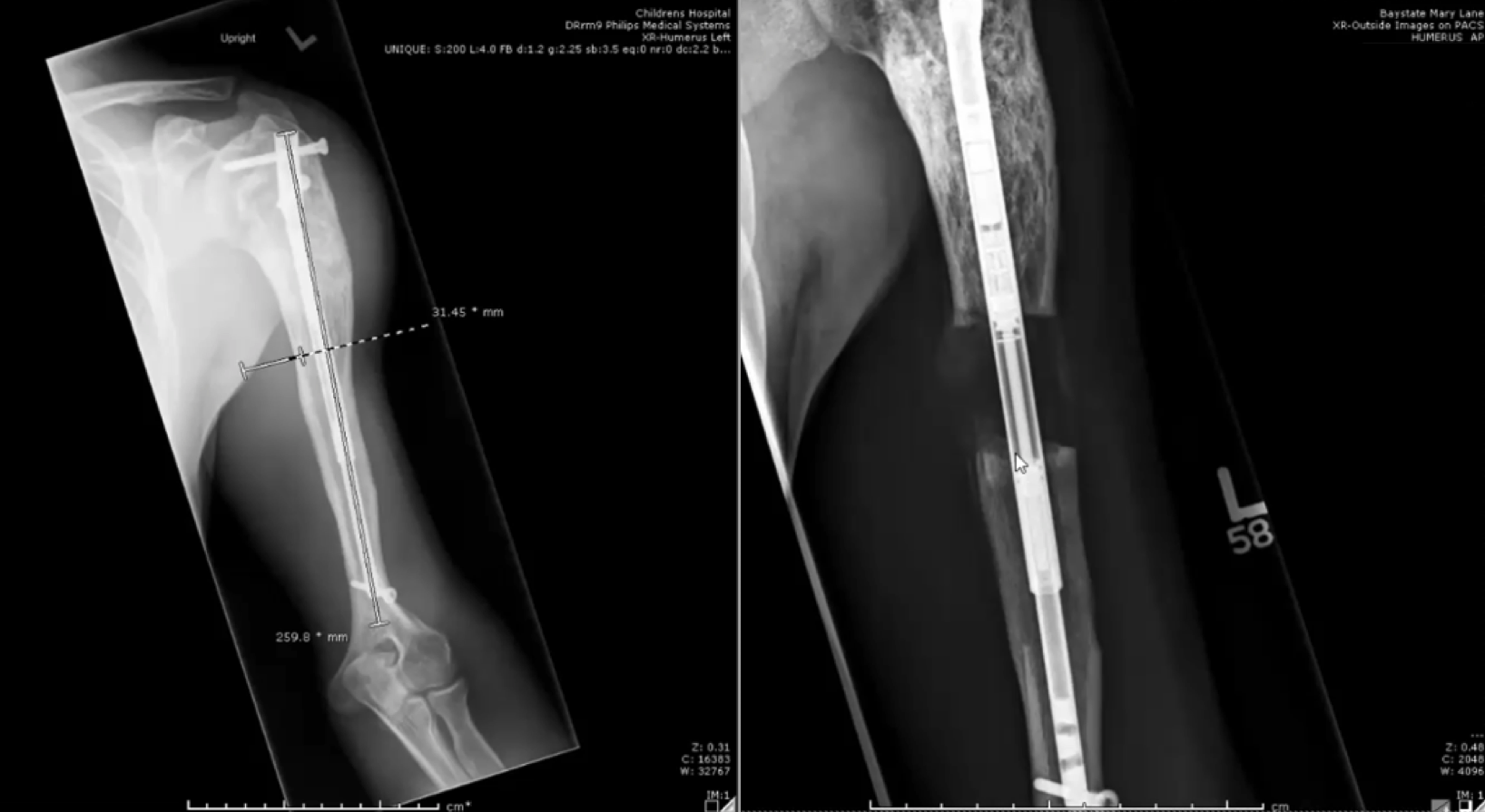 Intramedullary Nail for Proximal Humerus Fractures: An Old Concept  Revisited | Musculoskeletal Key