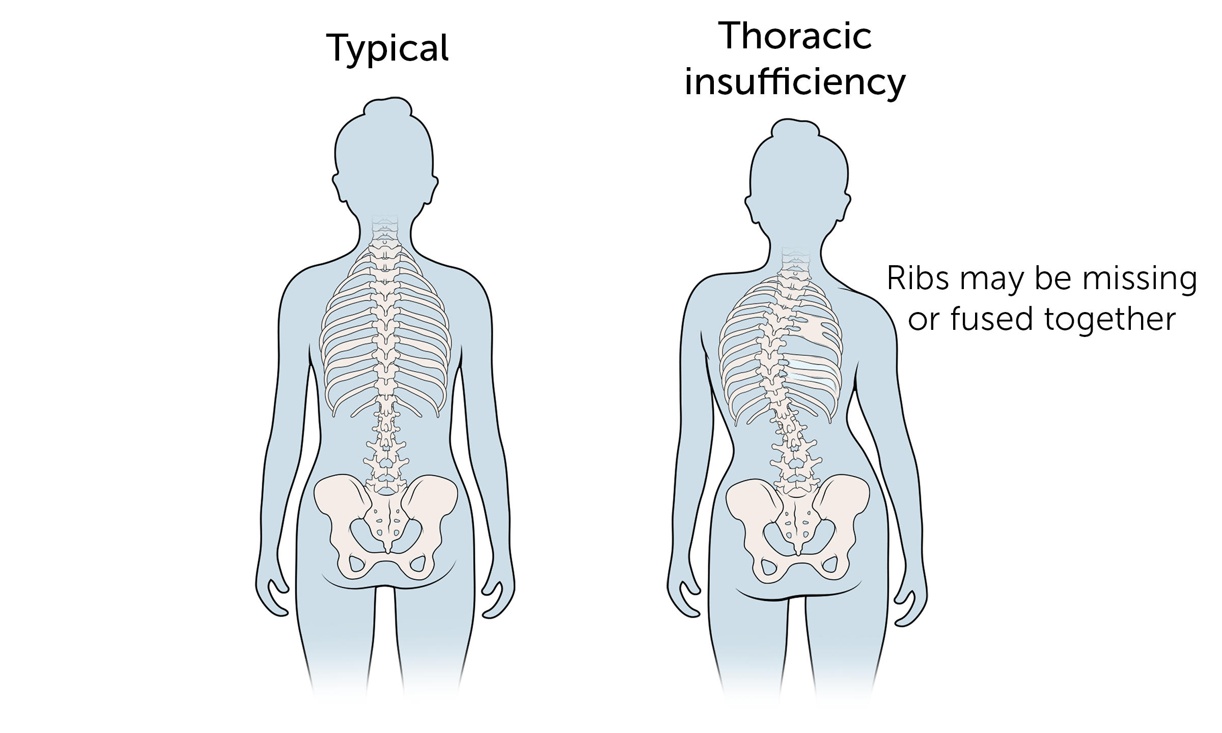 This is a typical skeleton and one with thoracic insufficiency syndrome.