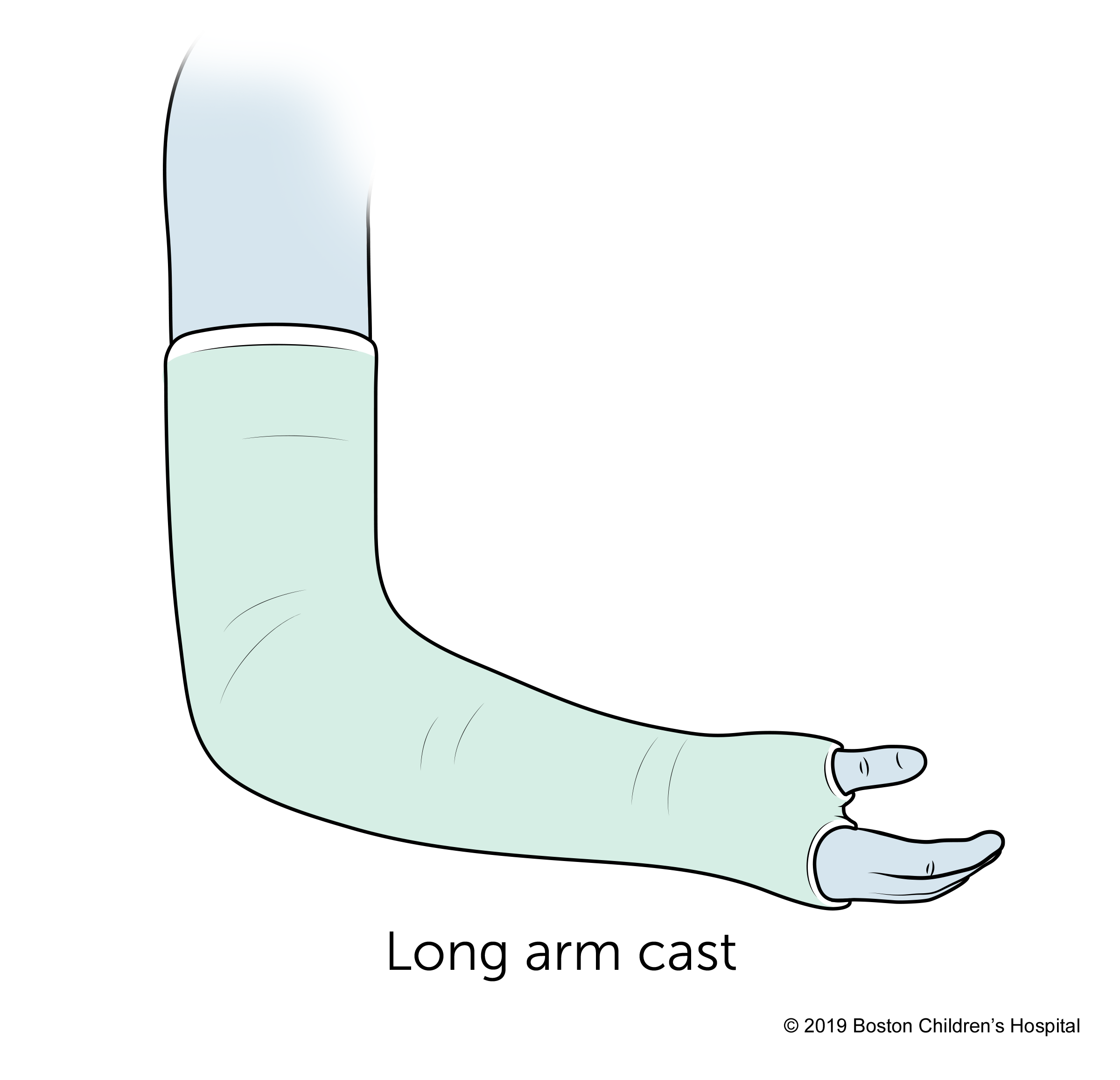 A long arm cast.