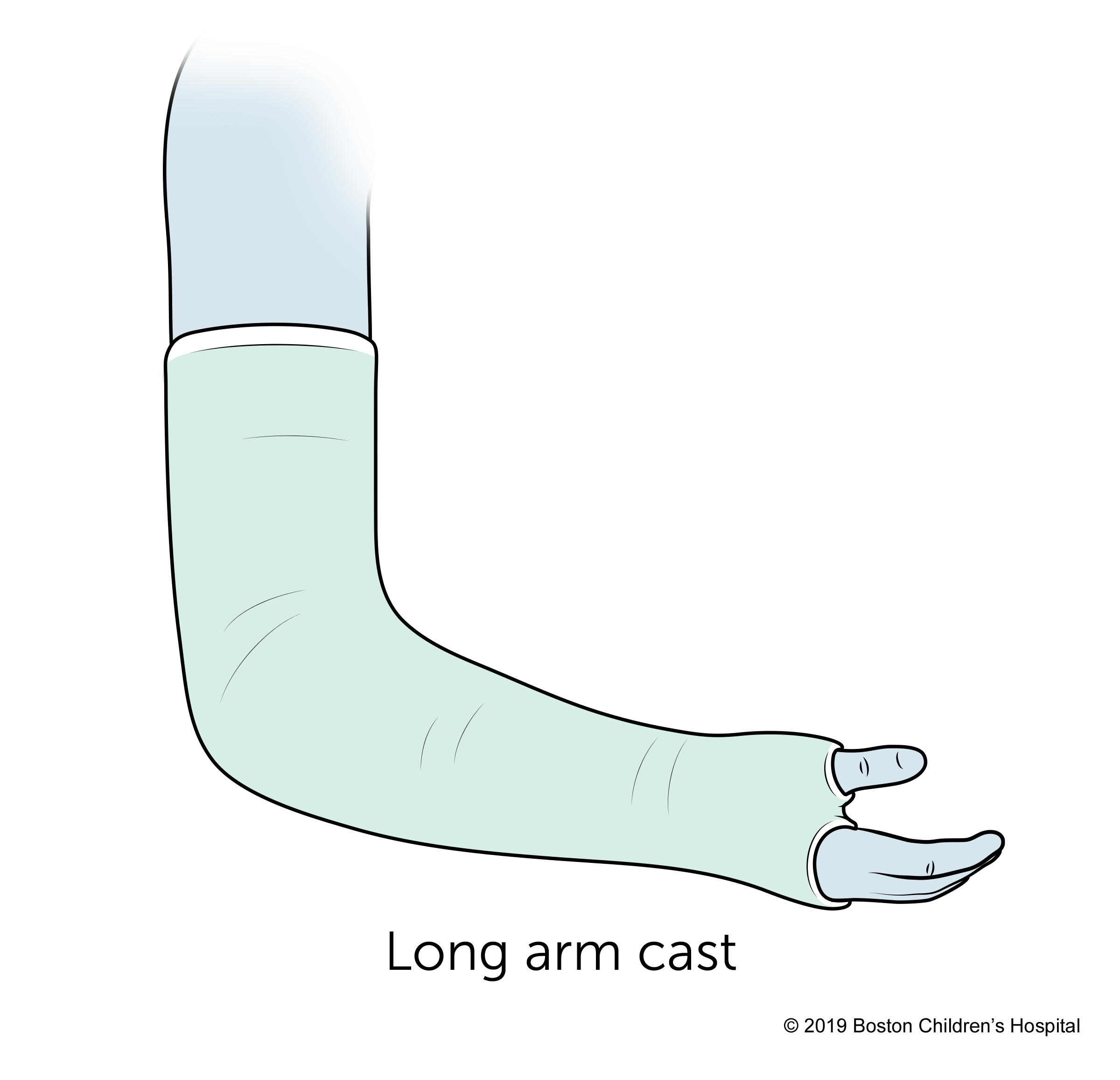 Types of Casts  Boston Children's Hospital