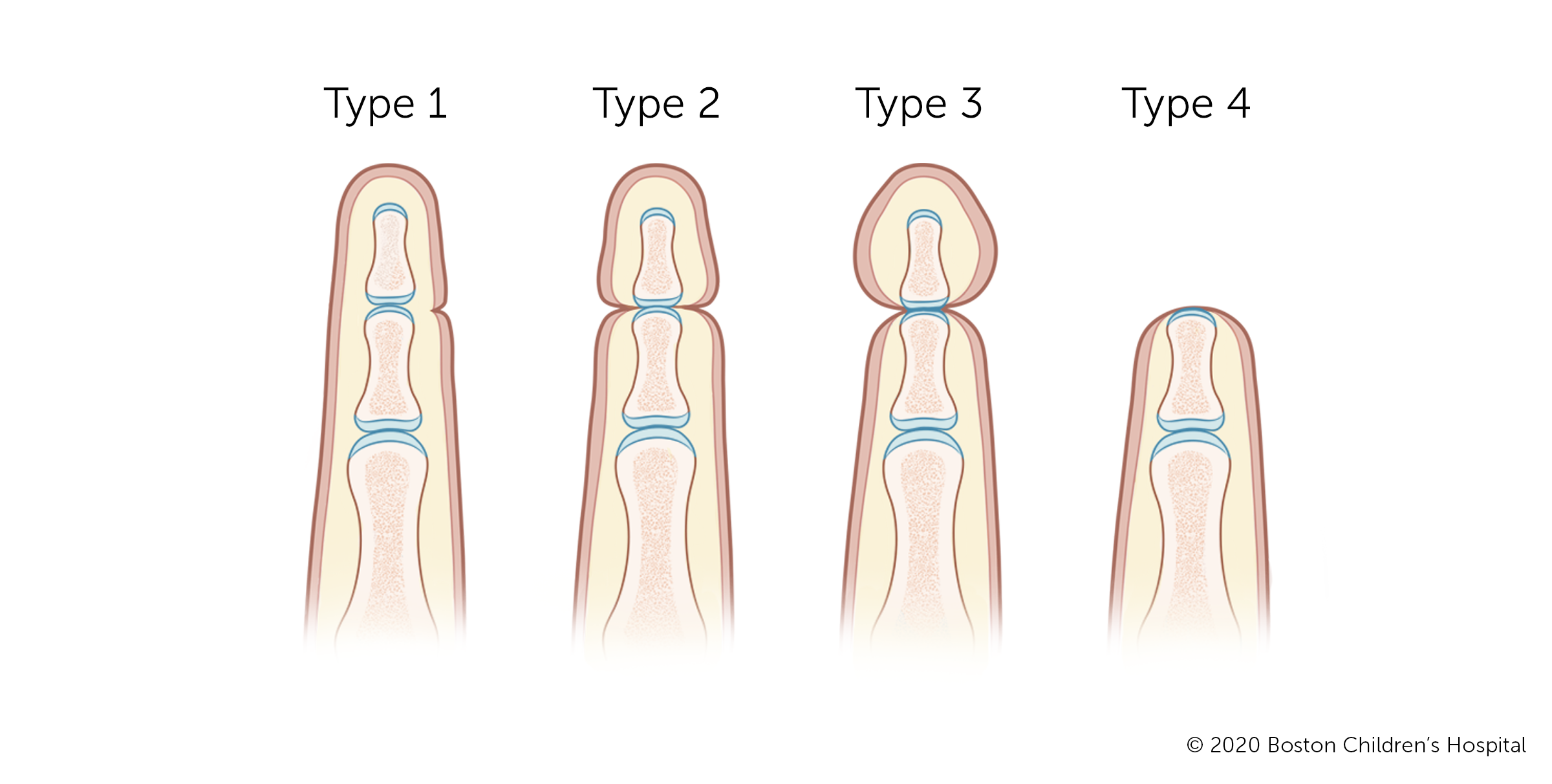 Four types of amniotic band syndrome shown on fingers. In type 1, there is only a small indentation. In type 2, the indentation cuts deeper into the flesh. In type 3, the indentation cuts all the way through the flesh to the bone. In type 4, the tip of the finger is completely missing.