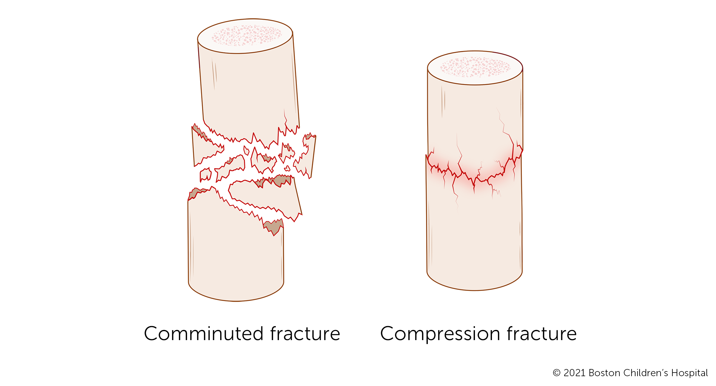 An illustration of severe fractures