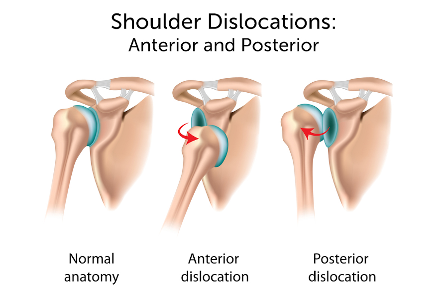 A shoulder dislocation can cause the humeral head to move to the front or the back of the glenoid.