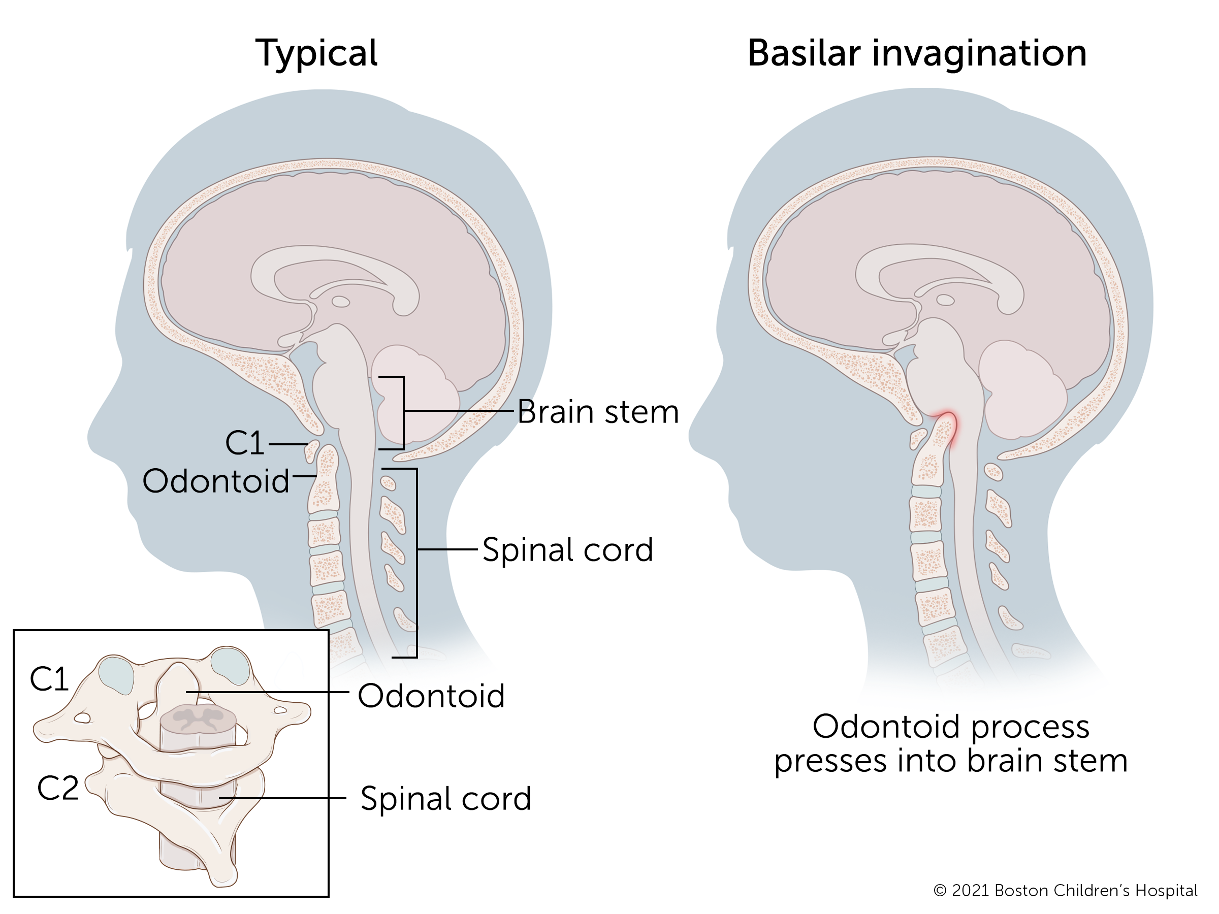 When a child has basilar invagination, a nob at the top of their spine presses into their brain stem.