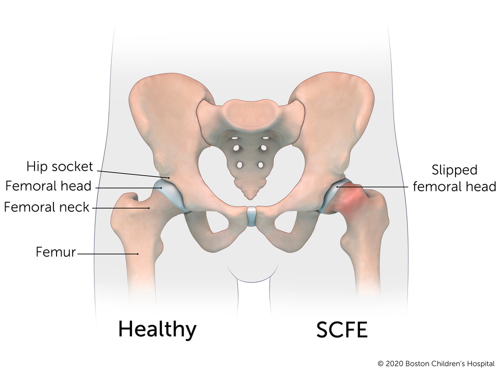 Here is the difference between a healthy hip and one with slipped capital femoral epiphysis.