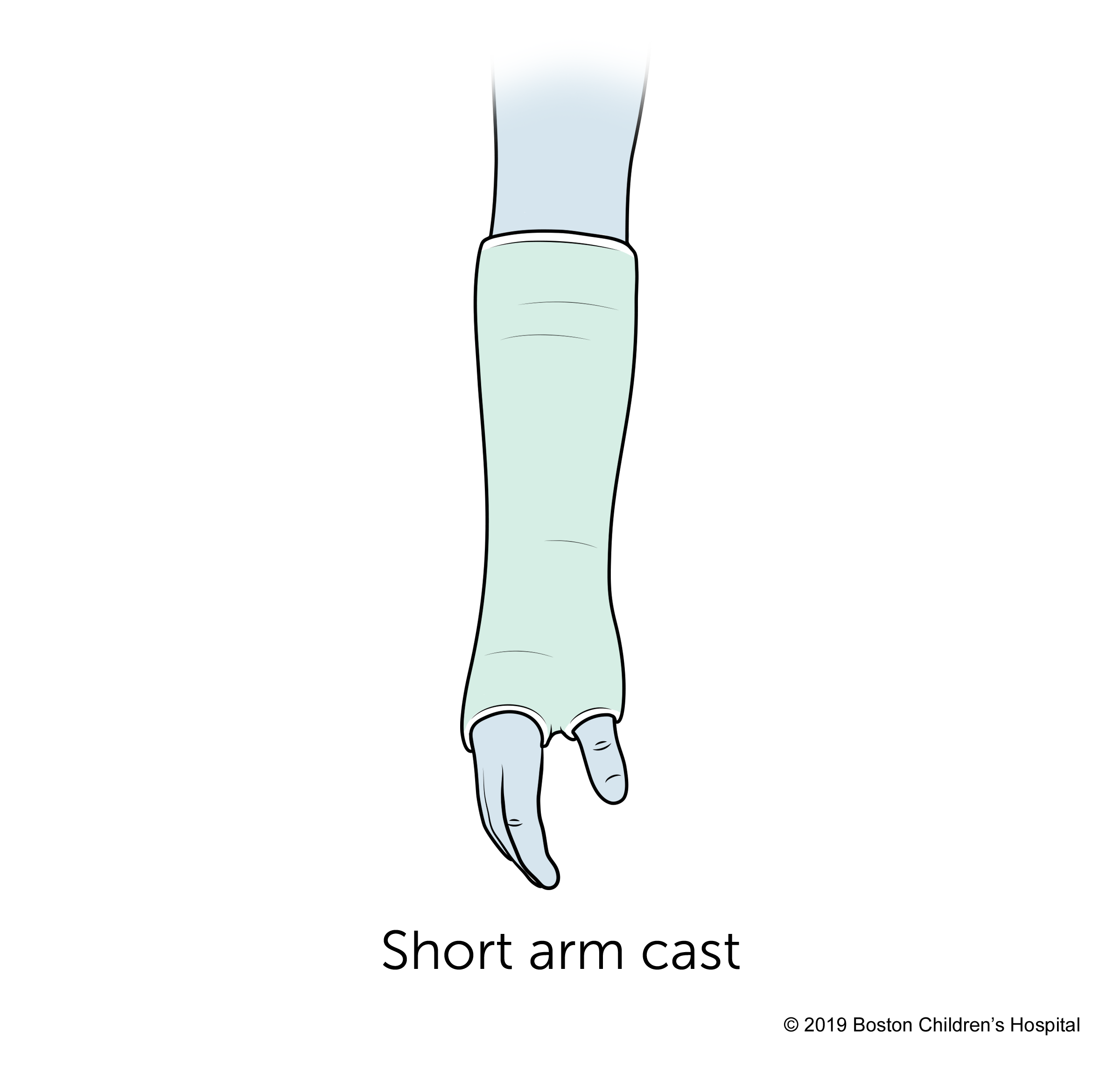 A short arm cast.