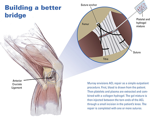 Building a Better Bridge: ACL Repair