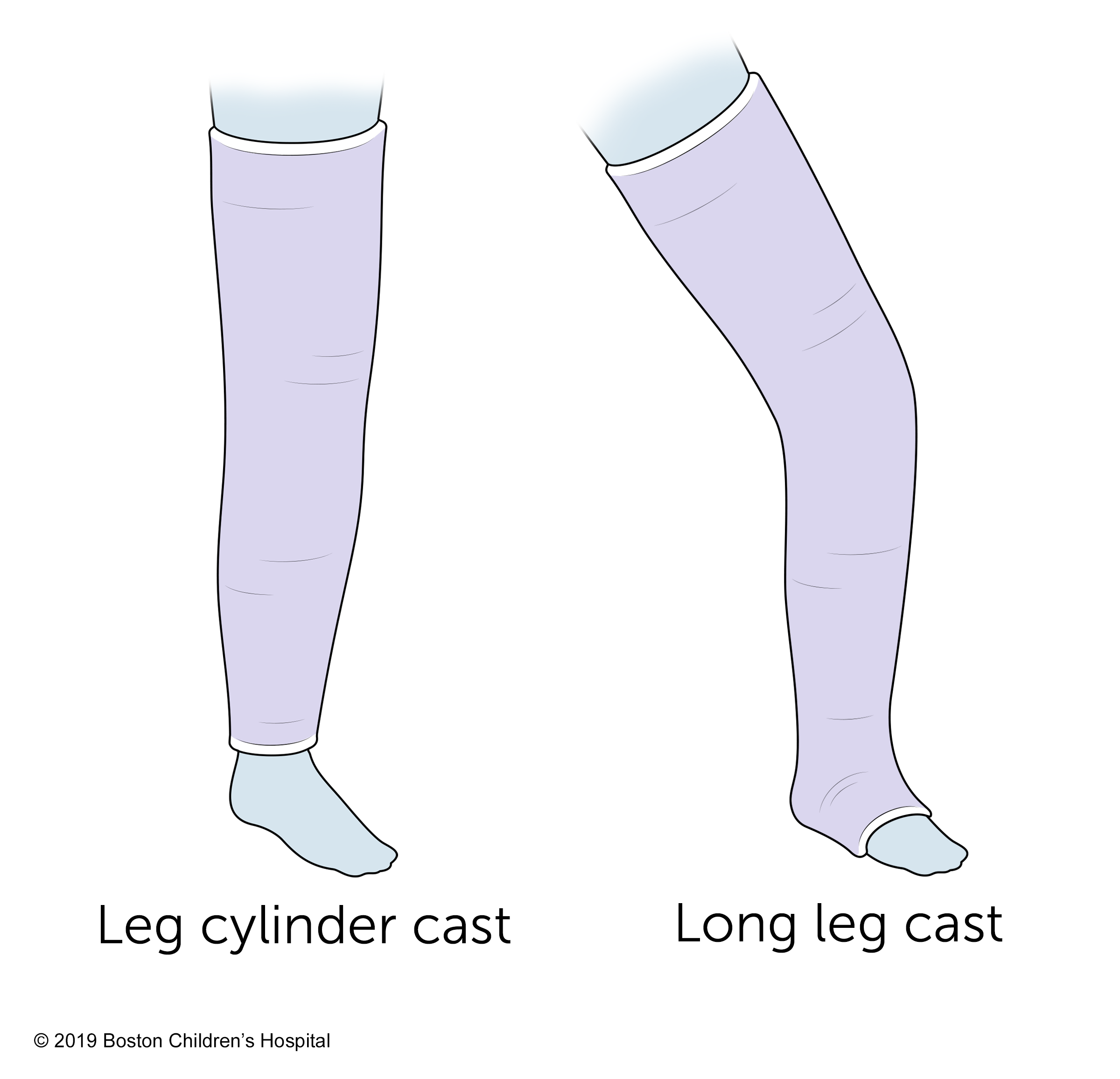 Leg cylinder and long leg casts