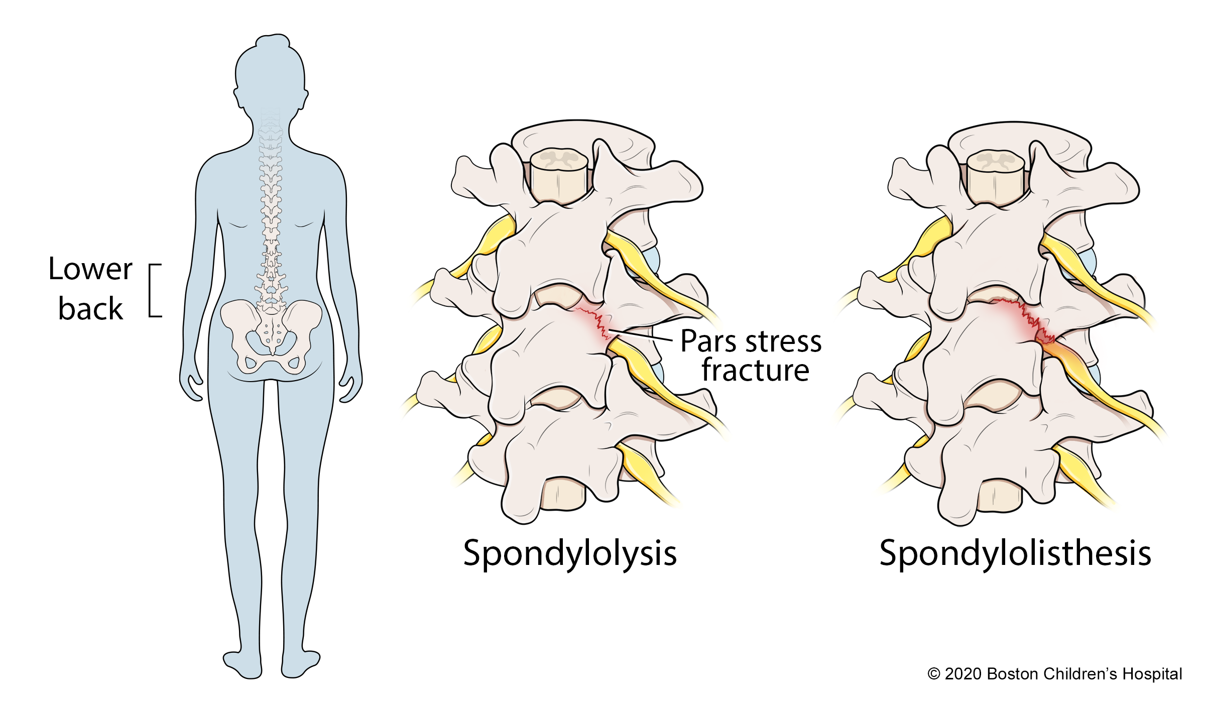 Spondylolisthesis in Athletes: Treatment and Return to Sports