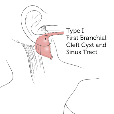Type-I-First-Branchial-Cleft-Cyst-Sinus-Tract