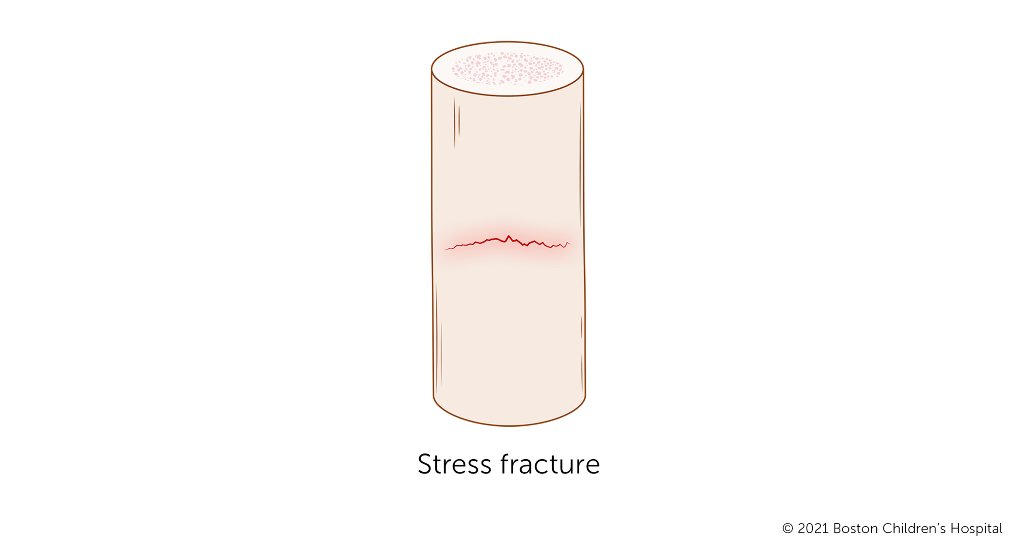 A stress fracture is a tiny crack that does not go all the way through the bone.