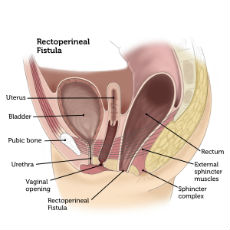 Rectoperineal Fistula