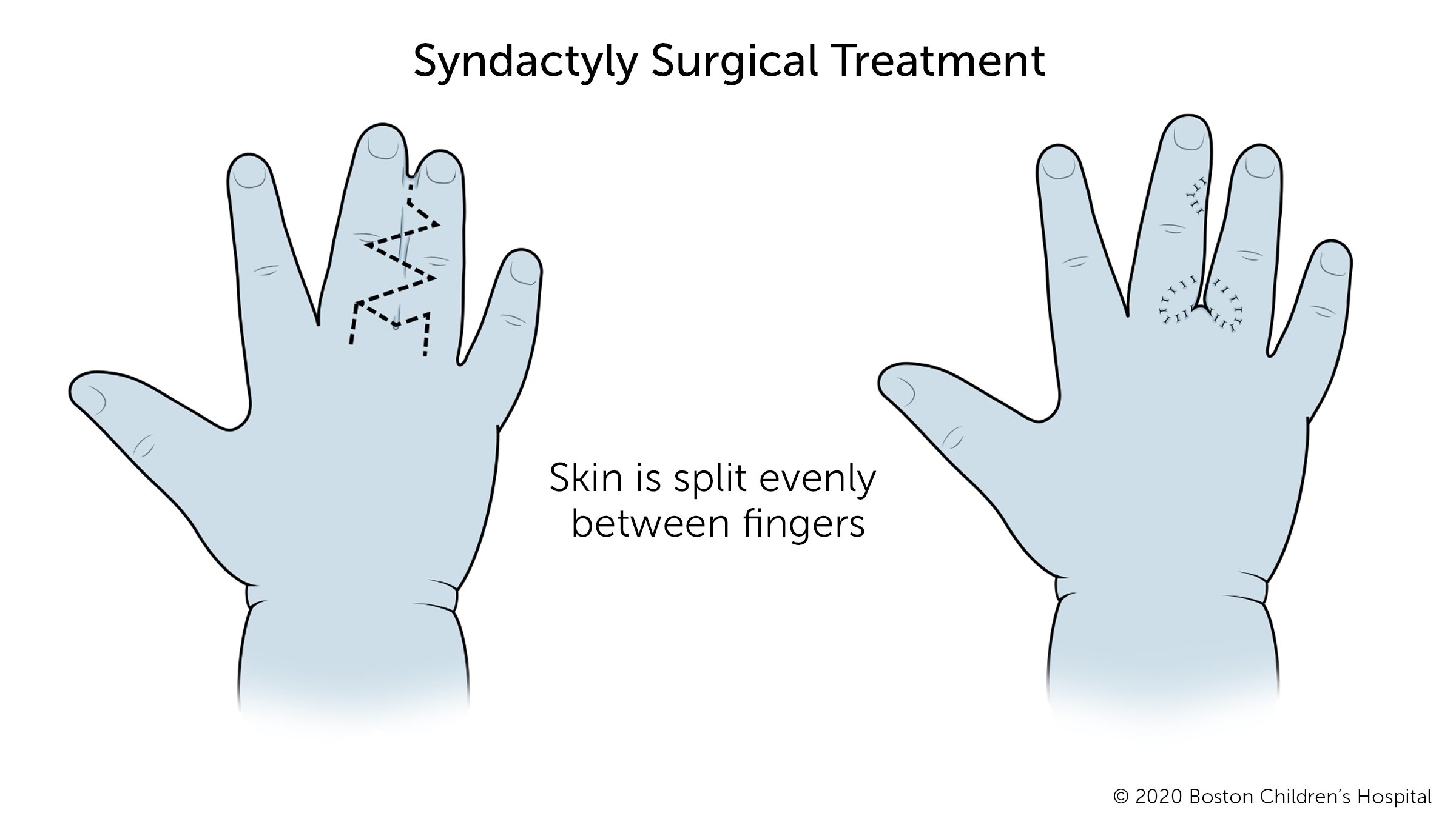 A before and after illustration of conjoined fingers that are surgically separated. Skin is split evenly between the fingers during surgery.