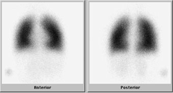 Ventilation/perfusion scan