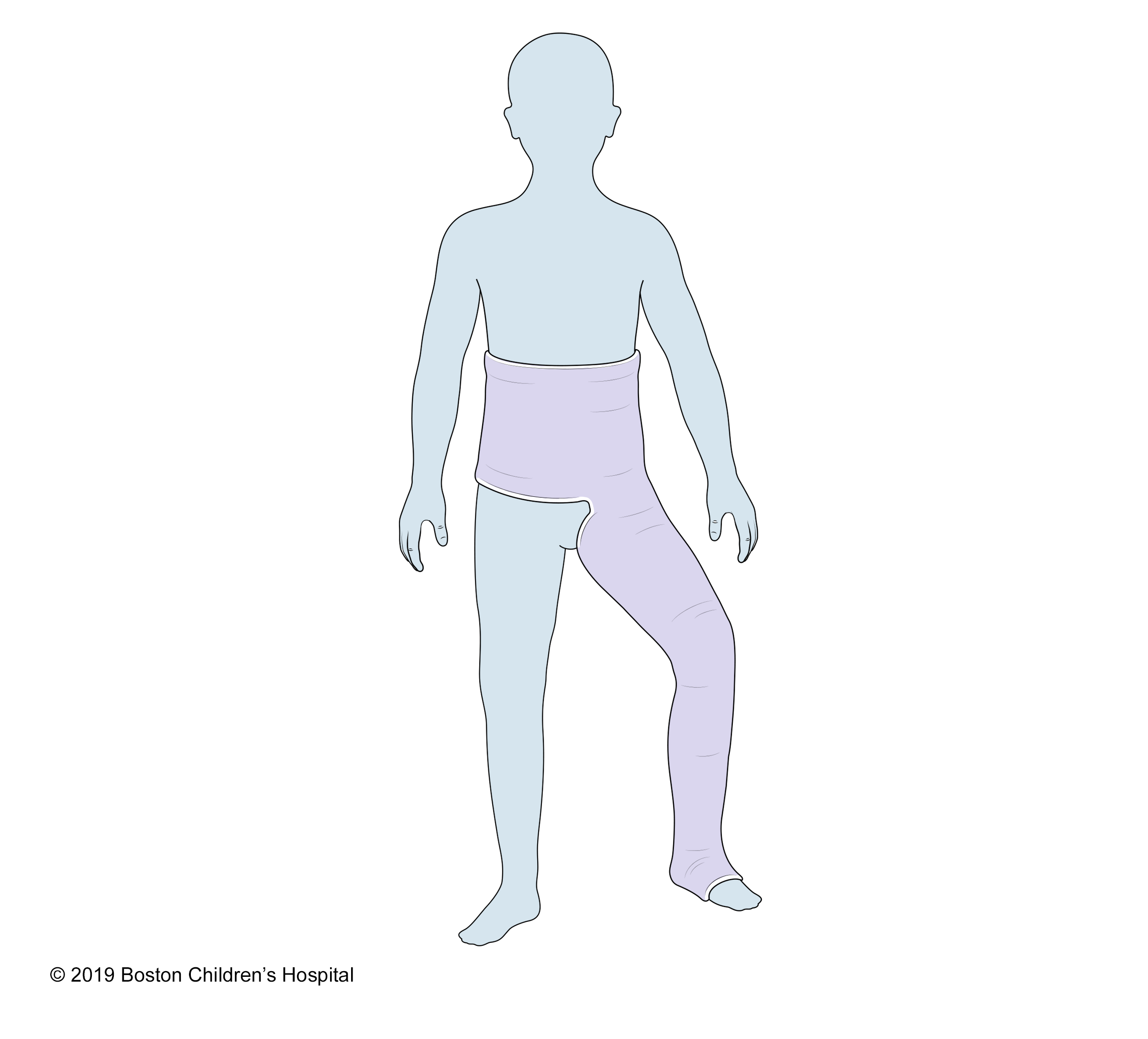 A unilateral hip spica cast (also known as single hip spica cast)